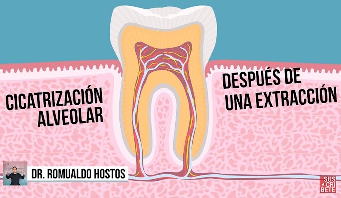 CICATRIZACIÓN ALVEOLAR: Proceso después de una extracción