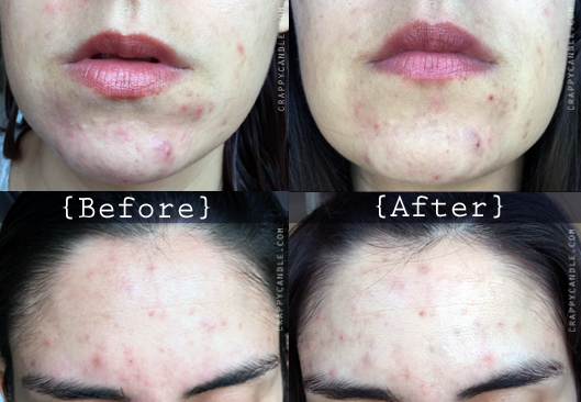 Non-Foaming Cleanser Before & After :: The Acne Experiment