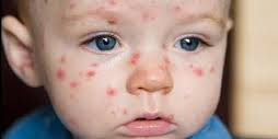 Image result for beza demam campak dan chicken pox