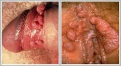 Obat Kutil Kelamin / Kondiloma De Nature di Samarinda Obat Kutil Kelamin / Kondiloma De Nature di Samarinda