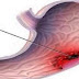 STOMACH CANCER: A SILENT KILLER – MOST COMMON SYMPTOMS (DON’T IGNORE THEM)