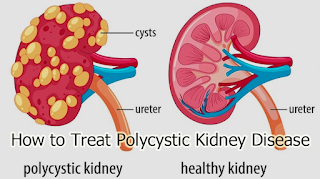 How to Treat Polycystic Kidney Disease
