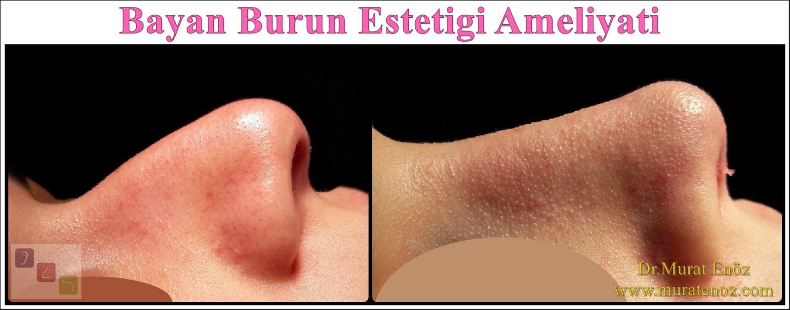 Bayan Burun Estetiği Ameliyatı