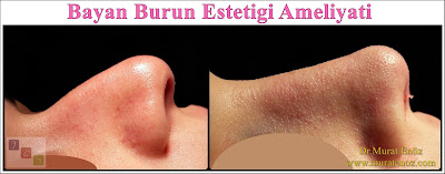 Rhinoplasty Istanbul - Rhinoplasty in Istanbul - Rhinoplasty Turkey - Rhinoplasty in Turkey – Rhinoplasty doctor in Istanbul – ENT doctor in Istanbul - Nose Job in Istanbul - Female Nose Aesthetic Surgery - Nose Jobs For Women - Nose Reshaping for Women - Best Rhinoplasty For Women Istanbul - Female Rhinoplasty Istanbul - Nose Job Surgery for Women - Women's Rhinoplasty - Nose Aesthetic Surgery For Women - Female Rhinoplasty Surgery in Istanbul - Female Rhinoplasty Surgery in Turkey Rhinoplasty Istanbul - Rhinoplasty in Istanbul - Rhinoplasty Turkey - Rhinoplasty in Turkey – Rhinoplasty doctor in Istanbul – ENT doctor in Istanbul - Nose Job in Istanbul - Female Nose Aesthetic Surgery - Nose Jobs For Women - Nose Reshaping for Women - Best Rhinoplasty For Women Istanbul - Female Rhinoplasty Istanbul - Nose Job Surgery for Women - Women's Rhinoplasty - Nose Aesthetic Surgery For Women - Female Rhinoplasty Surgery in Istanbul - Female Rhinoplasty Surgery in Turkey