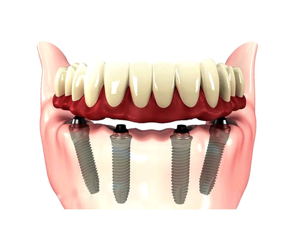 Crowns, fixed bridges and dental implants Guidelines Directorio Odontológico