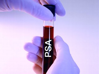 prostata screening test prostata screening test