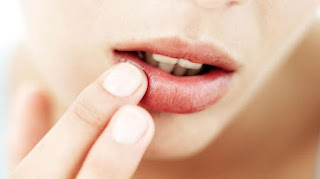 Cara Mudah Mengobati Bibir Pecah dan Kering Secara Alami Cara Mudah Mengobati Bibir Pecah dan Kering Secara Alami
