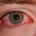 ☻ COMO CURAR la Conjuntivitis en pocos MINUTOS | 2019