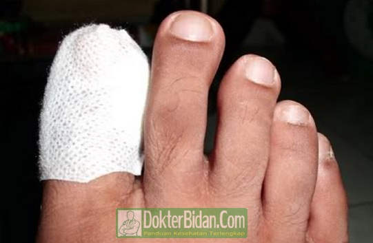 Penyakit Cantengan Kuku Jempol Kaki Busuk - Gejala Penyebab Dan Cara Mengobati Yang Sudah Parah Dengan Obat Salep Apotik Penyakit Cantengan Kuku Jempol Kaki Busuk - Gejala Penyebab Dan Cara Mengobati Yang Sudah Parah Dengan Obat Salep Apotik