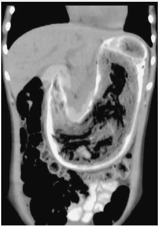 Bezoar Xray, Barium Studies, and CT Scan Examination RadTechOnDuty