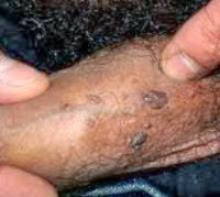 Obat alami untuk kutil di kelamin Bagaimana cara mengobati penyakit kutil kelamin
