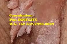 obat kutil kelamin obat kutil kelamin