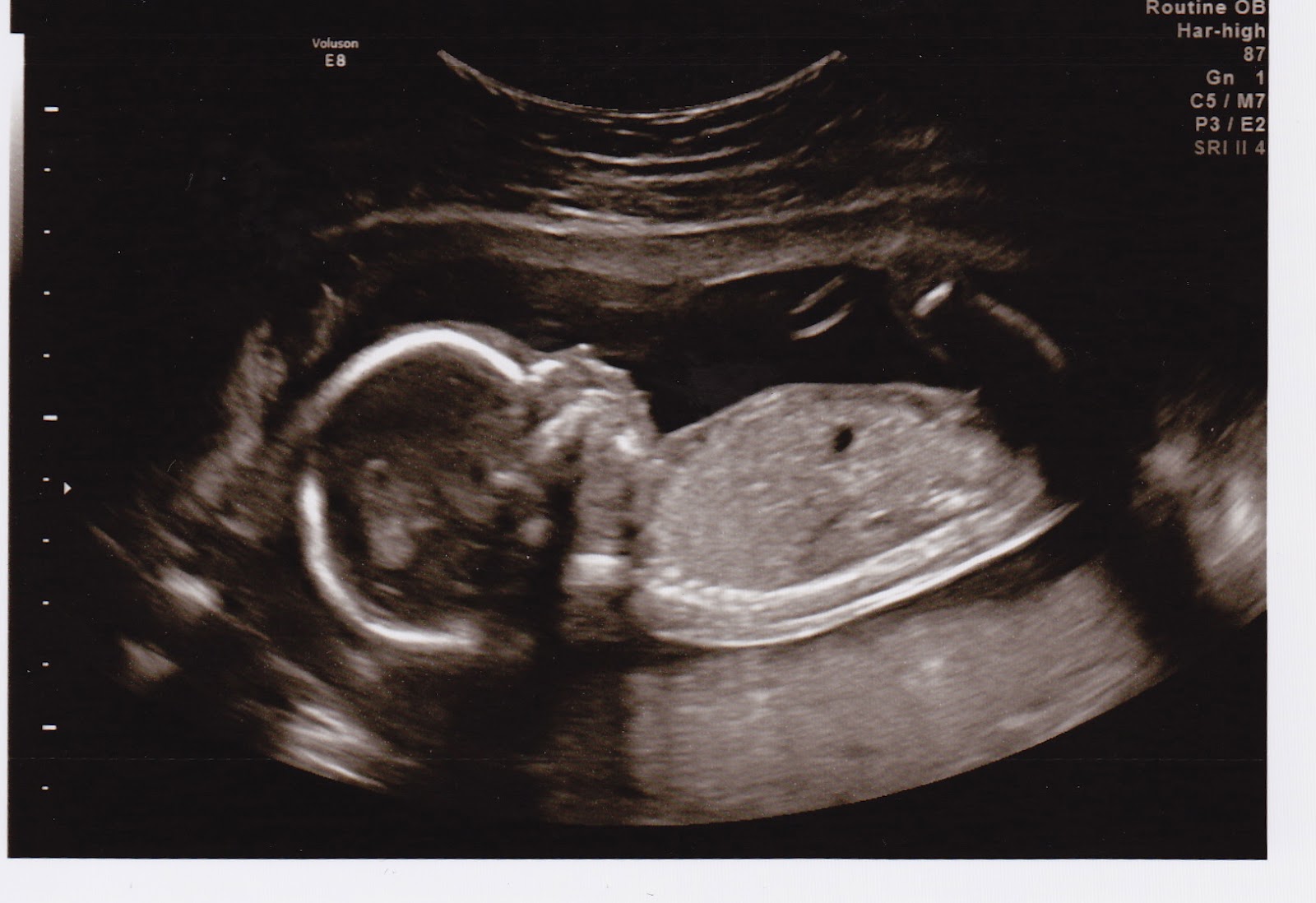 Waiting For Little Feet Anatomy Scan