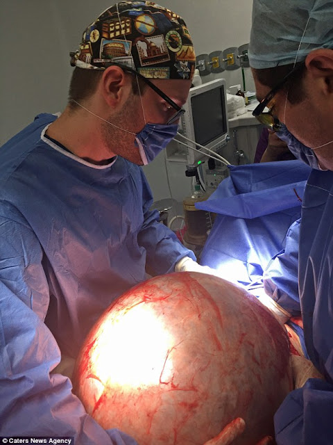 24-Year-Old Woman Has the World's Biggest Cyst Removed After Her Organs Were Crushed 24-Year-Old Woman Has the World's Biggest Cyst Removed After Her Organs Were Crushed