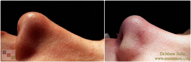Nasal Tip Plasty in İstanbul - Nose Tip Reshaping in İstanbul - Nose Tip Surgery in İstanbul - Nose Tip Lifting in İstanbul - Nose Tip Lifting With Permanent Surgical Technique - The External Strut Graft Technique - Droopy Nasal Tip Rhinoplasty - Droopy Nasal Tip Correction - Droopy Nasal Tip Surgery - Nasal Tip Ptosis - Droopy Tip Correction - Nose Tip Surgery