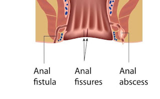 Best Homeopathic Remedy For Anal Fistula and Fissures