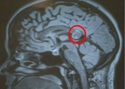 yamini karnam, fetus in brain, brain surgery  