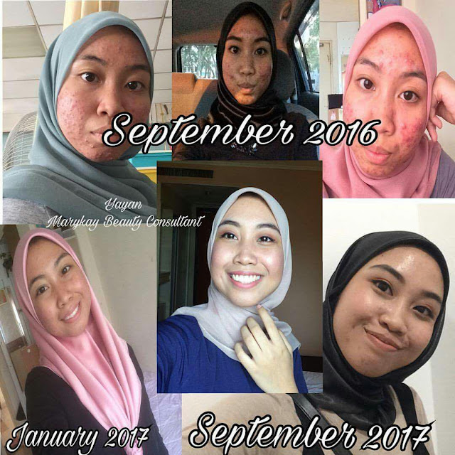 cara menghilangkan jerawat di muka cara menghilangkan jerawat di muka