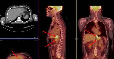 Tomografia por emissão de pósitrons ou PET/CT | Physics&Health