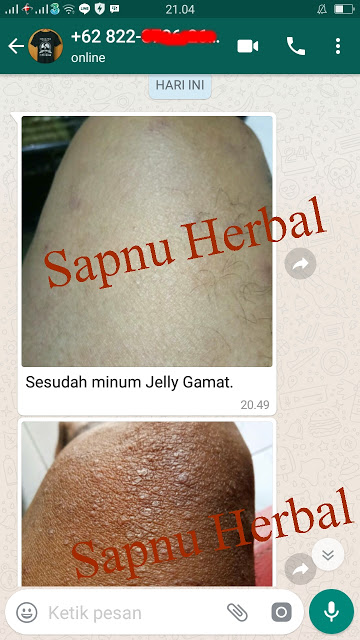 Cara Ampuh Mengobati Impetigo Secara Total Cara Ampuh Mengobati Impetigo Secara Total