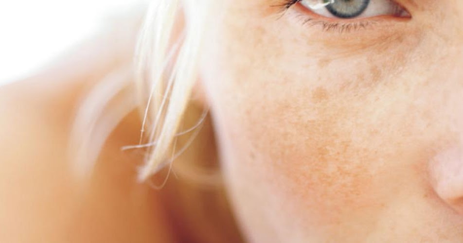 Dyschromia Definition, Symptoms, Causes, Treatment Health Care Tips and Natural Remedies