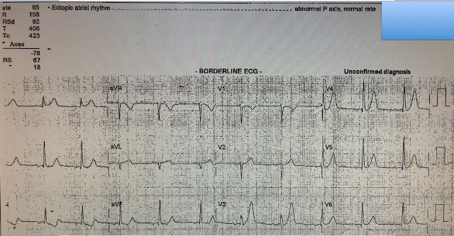 Does Ekg Miss Heart Problems In The Emergency Room Does Ekg Miss Heart Problems In The Emergency Room
