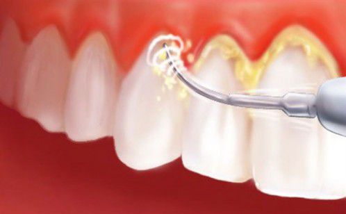 lấy cao răng 1 lần giá bao nhiêu tiền lấy cao răng 1 lần giá bao nhiêu tiền