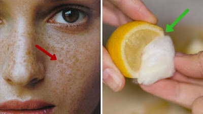 How To Get Rid Of Freckles (2 Steps) How To Get Rid Of Freckles (2 Steps)