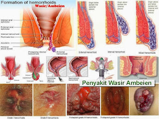 Foto Obat herbal ampuh wasir berdarah di apotik di jawa barat