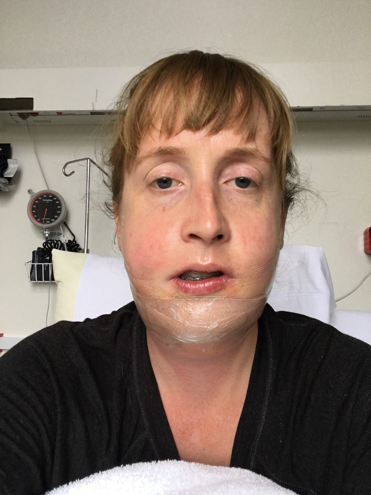 Swelling from jaw surgery