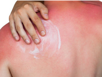 Bỏng nắng (cháy nắng) thường xảy ra vào mùa hè có thể chữa hiệu quả bằng thuốc