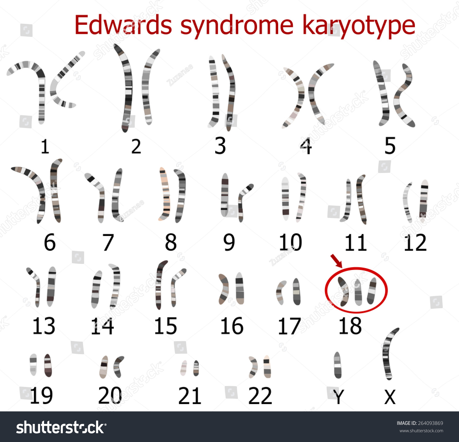 трисомия по 18 хромосоме кариотип. синдром эдвардса хромосомная карта. синдром эдвардса клиника. синдром эдвардса хромосомный набор кариотип. кариотип человека с синдромом эдвардса.