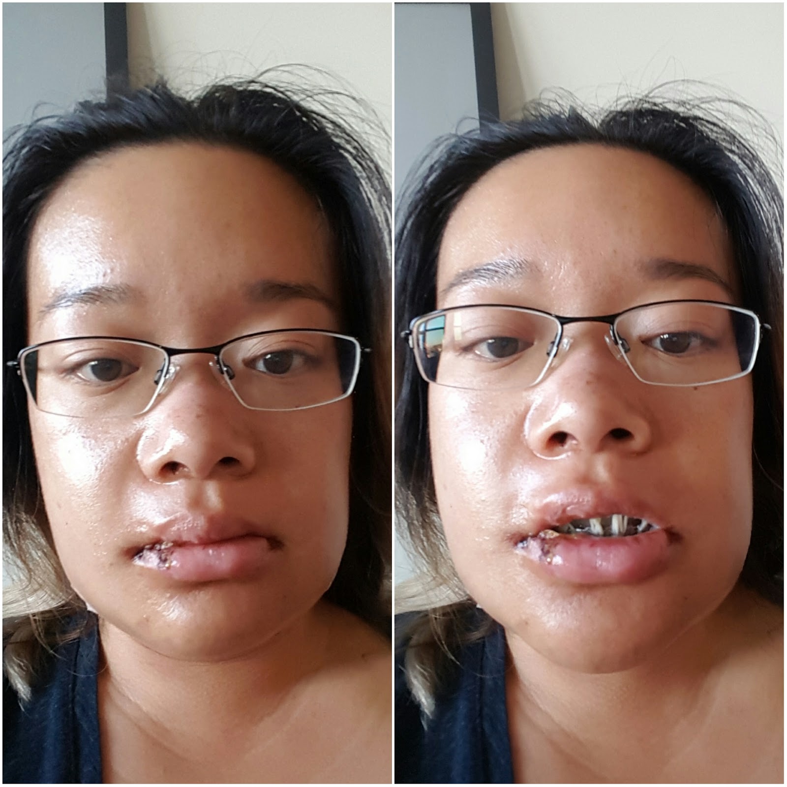 Tina's Double Jaw Surgery Day 2 Swelling Increasing Happy Halloween!