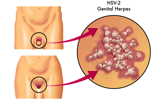  ஹெர்பிஸ் – Herpes  என்ற பால்வினை சரும நோய் சிகிச்சை 