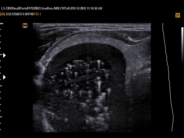 VIETNAMESE MEDIC ULTRASOUND: CASE 157: THYROID CYST with COMET TAIL ...