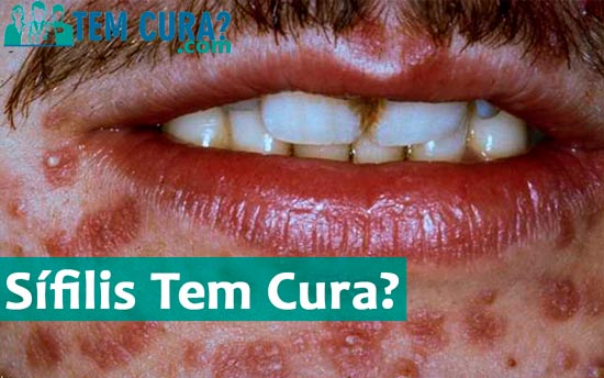 HPV Tem Cura? - O que o V rus 39 HPV Tem Cura? - O que o V rus 56