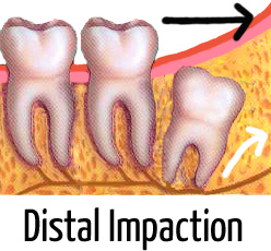 infected wisdom tooth pictures (distal impaction)