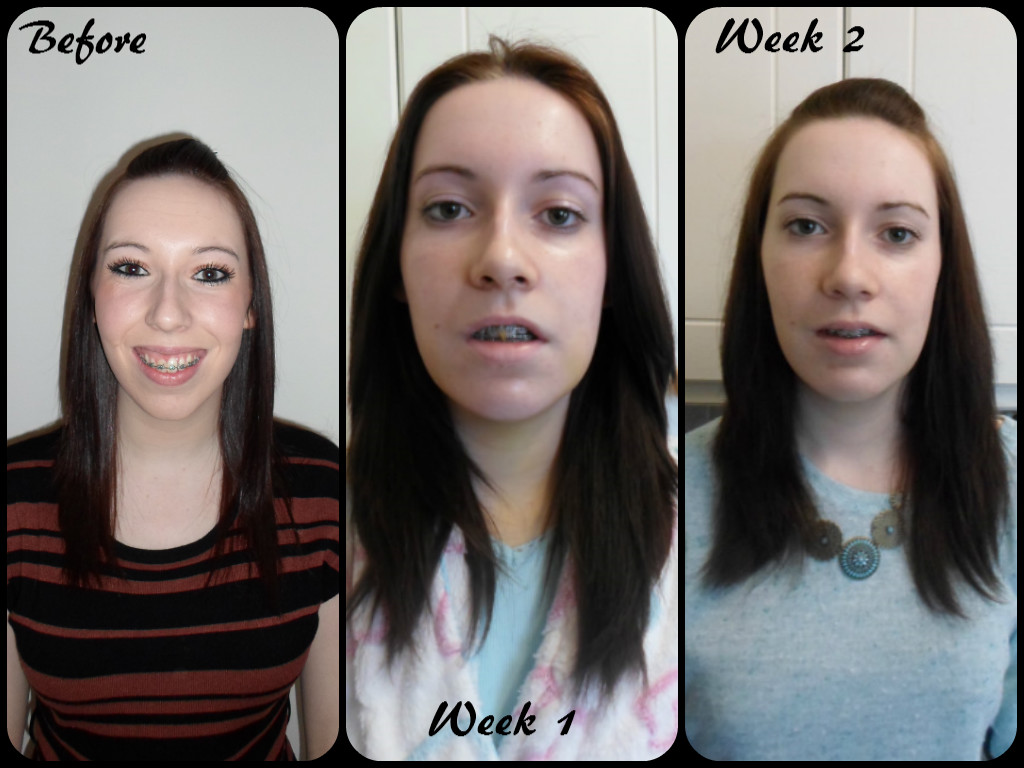 My jaw surgery and I.. Day 40+ 6 weekish update!