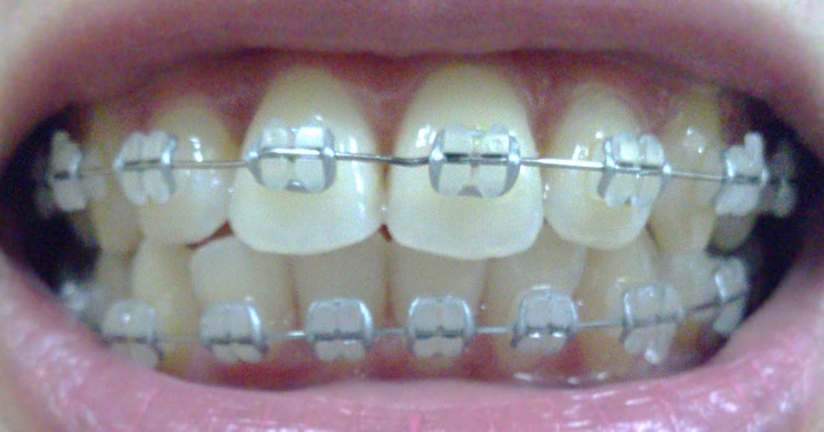 Silver Ligatures Braces Catalog of Orthodontic Products by Auradonics