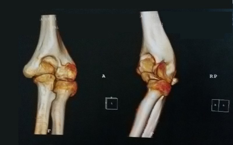 Fisioterapia per tutti: Frattura del gomito