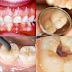 Trám răng có đau không bác sỹ?