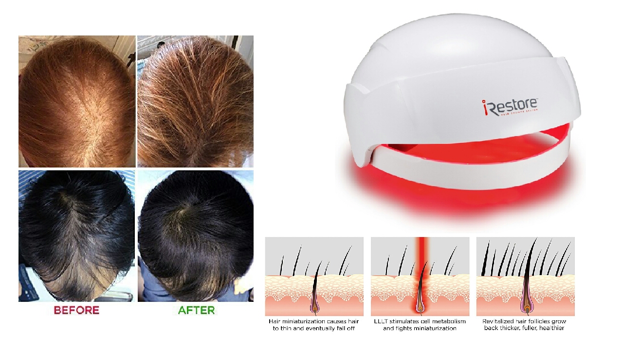 irestore laser hair growth system fda cleared hair loss treatment for men and women with balding and thinning laser helmet uses regrowth light therapy - Laser Hair Treatment irestore laser hair growth system fda cleared hair loss treatment for men and women with balding and thinning laser helmet uses regrowth light therapy - Laser Hair Treatment