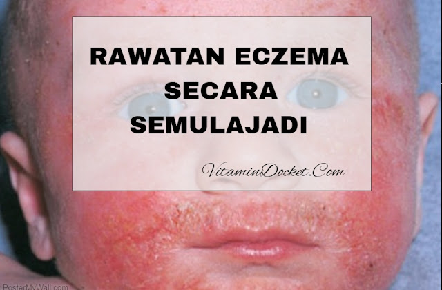  rawatan eczema