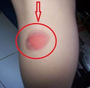 Cara Menghilangkan Bekas Luka Knalpot