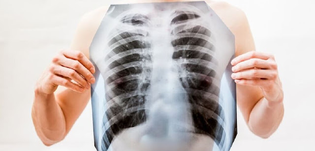 5 Kinds of Lung Diseases that Should be Known 5 Kinds of Lung Diseases that Should be Known