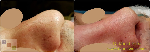 Burun estetiği ile birlikte septum perforasyonu kapatılması - Burun septumunda delik kapatılması - Burun septum perforasyonu ameliyatı - Erkek burun estetiği - Septum perforation closure in Istanbul - Septum perforation closure with under skin tissue - Closure of nasal septal perforations using under skin tissue - Combining rhinoplasty with septal perforation repair - Rhinoplasty in men Istanbul - Nose job in men Istanbul - Rhinoplasty in men Turkey - Erkek burun estetiği fotoğrafları - Burun estetiği Bakırköy Burun estetiği ile birlikte septum perforasyonu kapatılması - Burun septumunda delik kapatılması - Burun septum perforasyonu ameliyatı - Erkek burun estetiği - Septum perforation closure in Istanbul - Septum perforation closure with under skin tissue - Closure of nasal septal perforations using under skin tissue - Combining rhinoplasty with septal perforation repair - Rhinoplasty in men Istanbul - Nose job in men Istanbul - Rhinoplasty in men Turkey - Erkek burun estetiği fotoğrafları - Burun estetiği Bakırköy