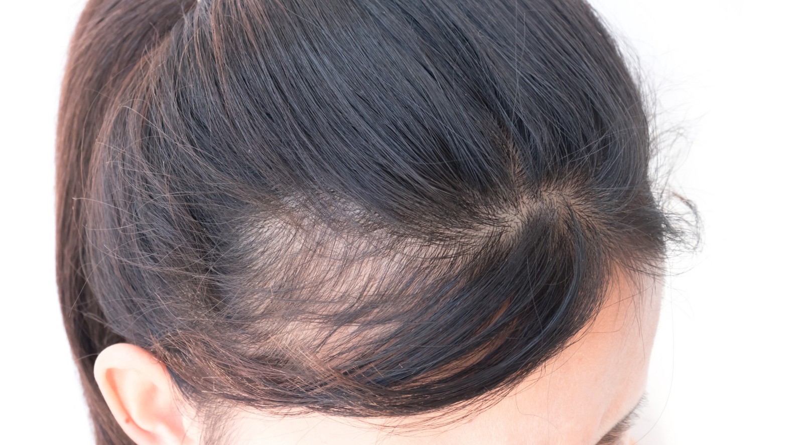 Hair Transplant Hair Loss In Women Causes And Treatments