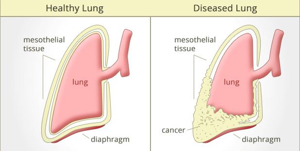 common cause of mesothelioma