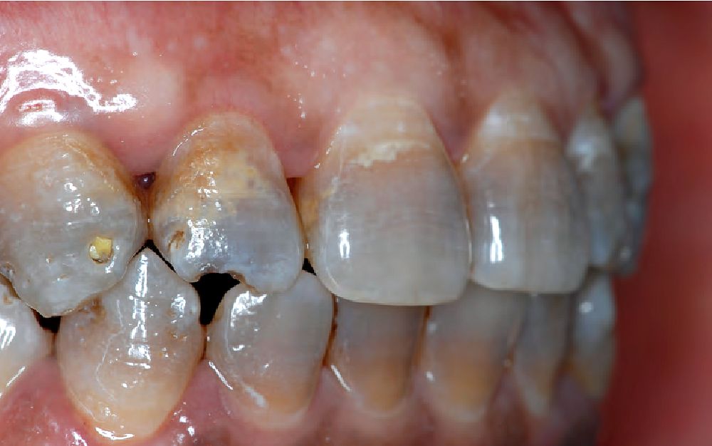 Tooth Discoloration