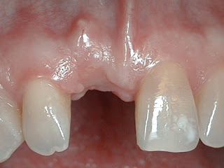 Mất 1 răng nên làm cầu răng hay Implant thì tốt?